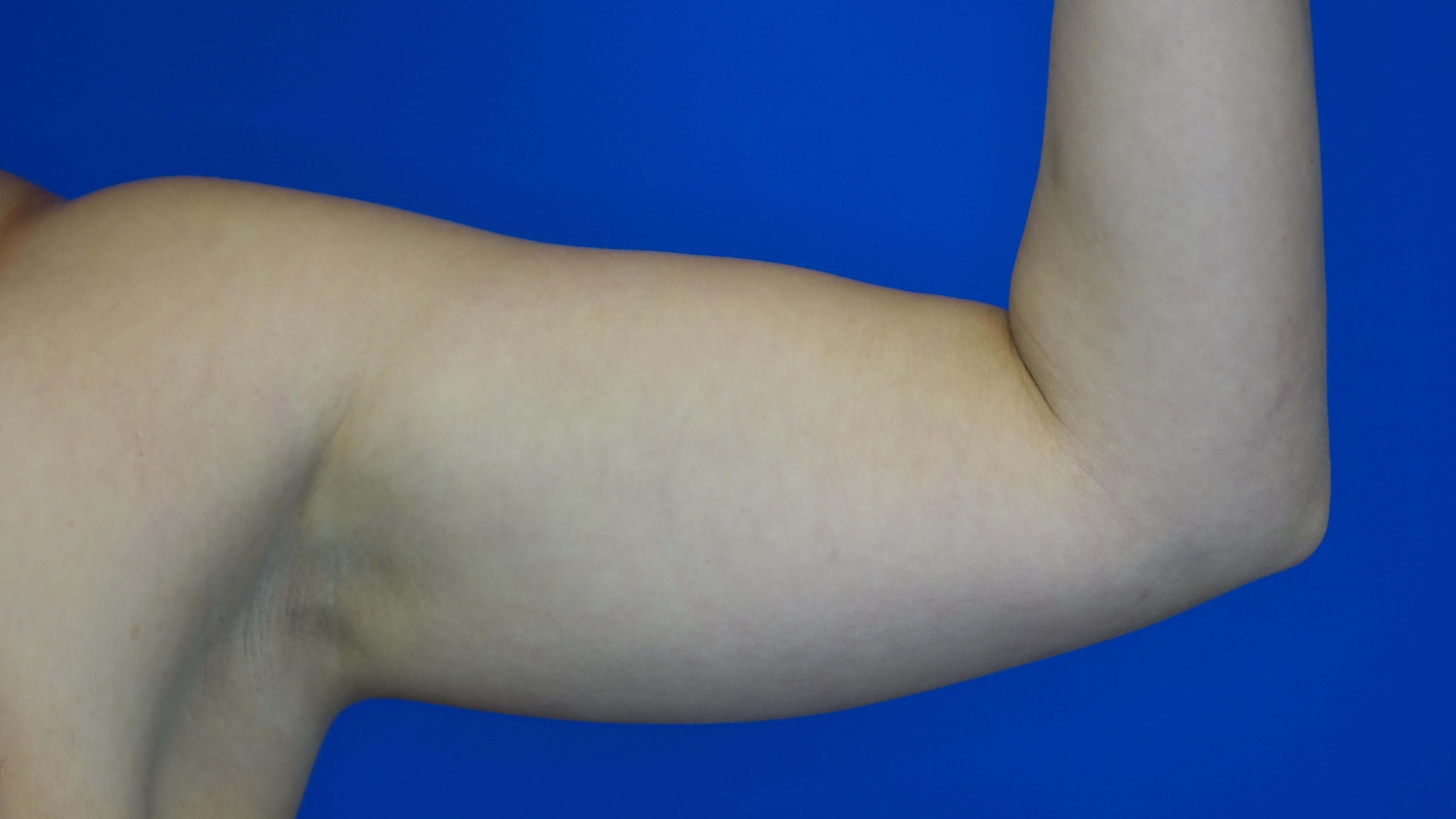 Liposuction of the Arms